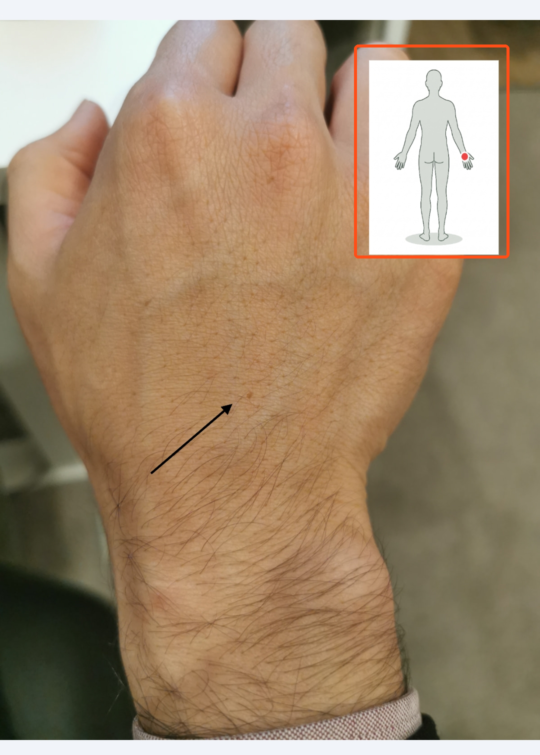 The body map inset moved aside